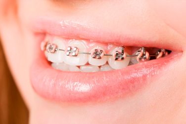 Clínica Dental El Zurguén joven con brackets