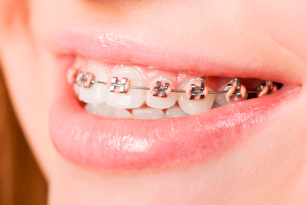 Clínica Dental El Zurguén joven con brackets